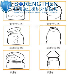 如何分辨包皮过长和包茎?