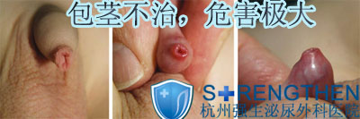 包茎不治,危害极大!
