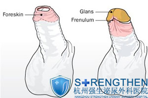 包皮过长引起早泄