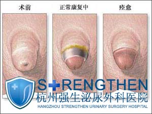 包皮包茎与早泄的关系
